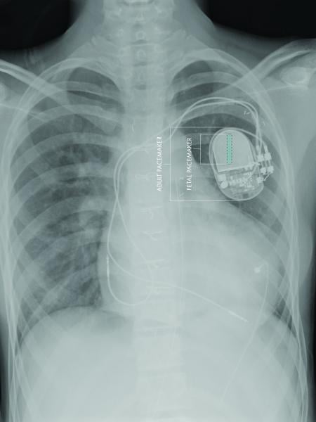 fetal pacemaker, CHLA, USC, first, fully implantable, FDA