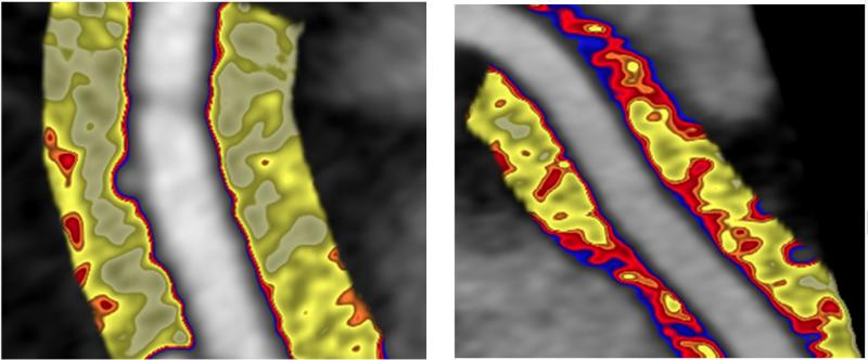 A comparison between healthy artery (left) and inflamed artery (right) using perivascular fat attenuation index (FAI) mapping to detect spatial changes in perivascular fat composition induced by inflammation of the vascular wall caused by high-risk plaques.