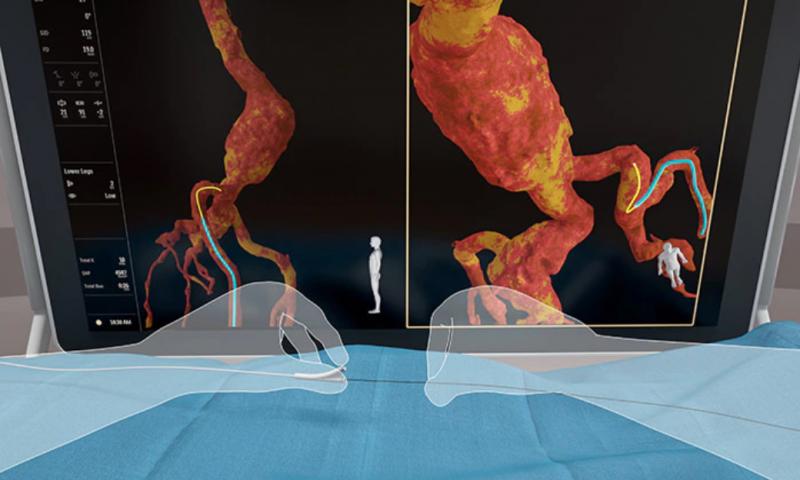 Philips Healthcare's new Fiber Optic RealShape (FORS) technology creates real-time 3-D imaging of anatomy and devices inside the body using light, rather than X-rays. FORS uses light traveling through hair-thin fiber optics inside special FORS enabled catheter and guidewires. 