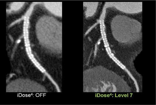An example of iterative reconstruction image reconstruction to improve the image quality of low dose CT scans to enable lower dose imaging