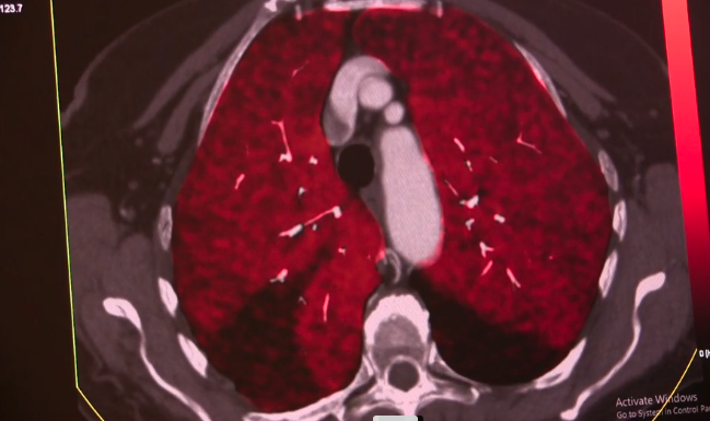Bilateral pulmonary embolisms seen on spectral CT. Photo courtesy of Siemens Healthineers.