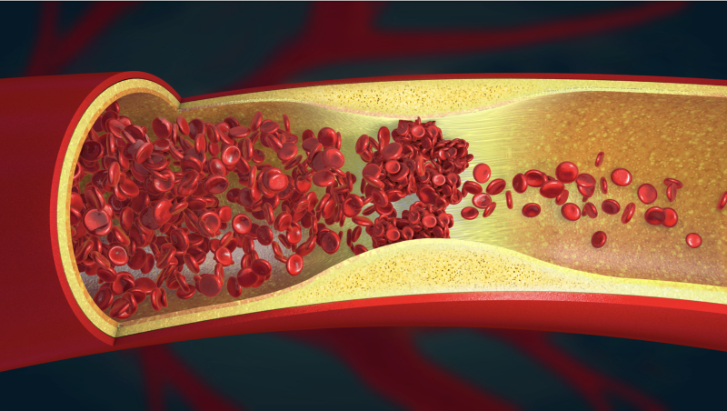 A rise in cardiovascular diseases has fueled technological advancements in thrombectomy devices