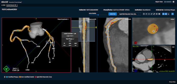 plaque, coronary artery disease, CCTA
