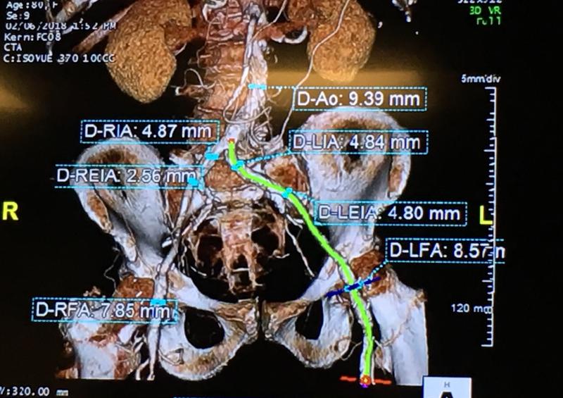 A CT scan assessment of the femoral access route challenges for a recent Central DuPage Hospital TAVR candidate. This image and the measurements were discussed by the heart team during its weekly meeting to determine if the TAVR delivery catheters could navigate the disease femoral artery and what options might best serve this patient. 
