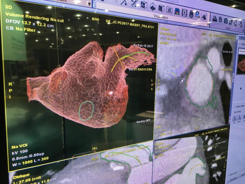 All major vendors offering advanced visualization software now offer structural heart planning. This is an example of GE Healthcare's Valve Assist software being used to determine the best location of a transseptal puncture to deliver a left atrial appendage (LAA) occluder. 