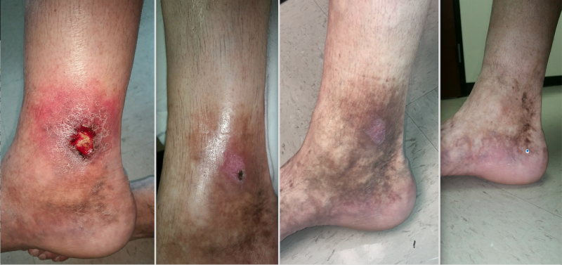 A patient case study showing a venous ulcer formation 18 months following thermal ablation varicose vein treatment in the GSV. The patient was treated with Varithena polidocanol endovenous microfoam chemical-ablation. Images show baseline prior to treatment (right), followed by one, four and six weeks after treatment. The treatment is also called sclerotherapy.