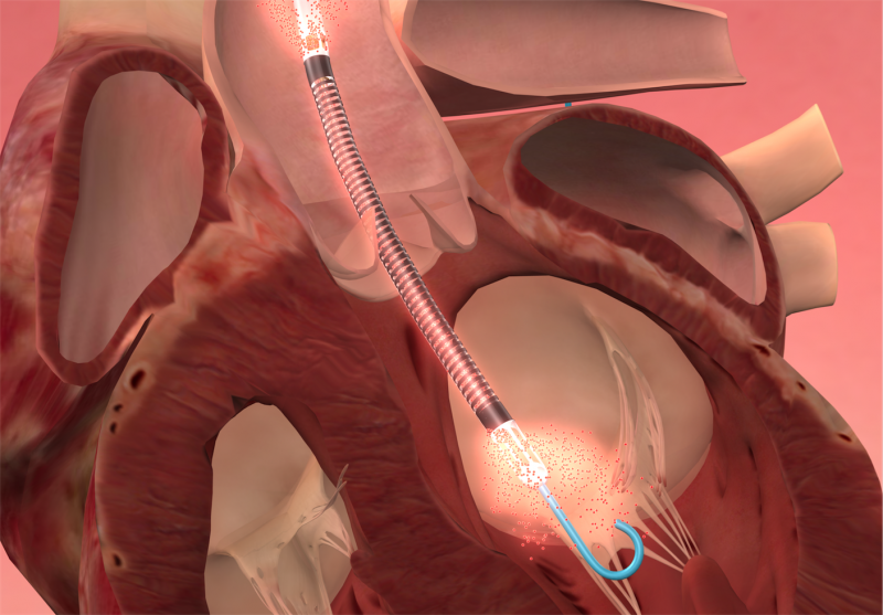 the Impella pVAD improves survival, mortality in AMI heart attack with cardiogenic shock