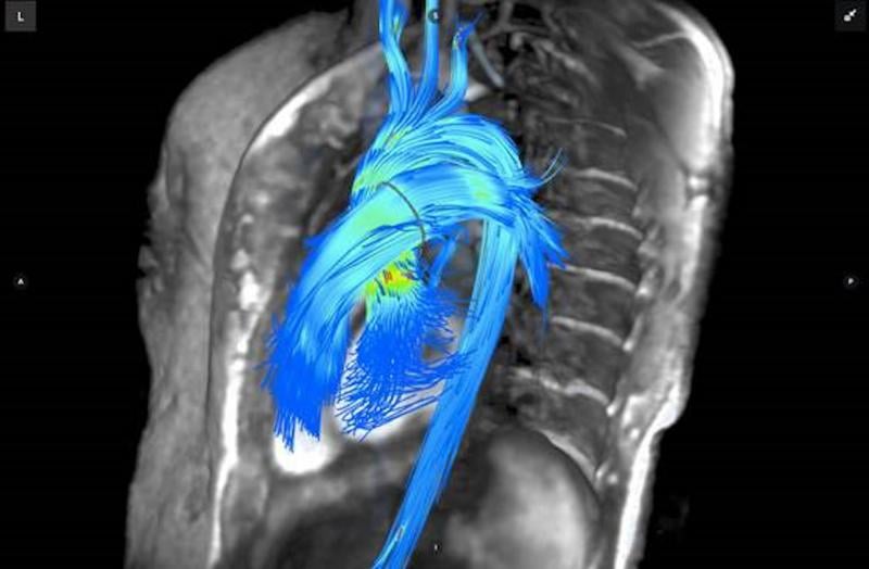 Arterys, Cardiac MRI, cardiac MRI advances