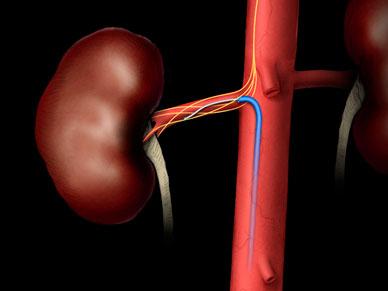 An example of renal denervation therapy being delivered. A catheter is inserted into the renal artery to ablate the nerves in the vessel wall that regulate vasoconstriction. This leaves the vessel permanently in the widest open position to allow greater blood flow to the kidneys.