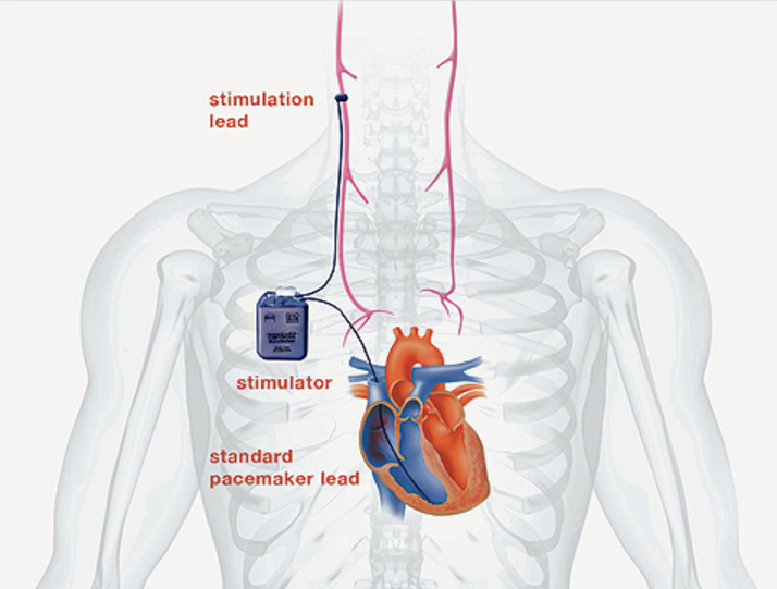 cardiofit, vagus nerve stimulation for heart failure, bio control medical
