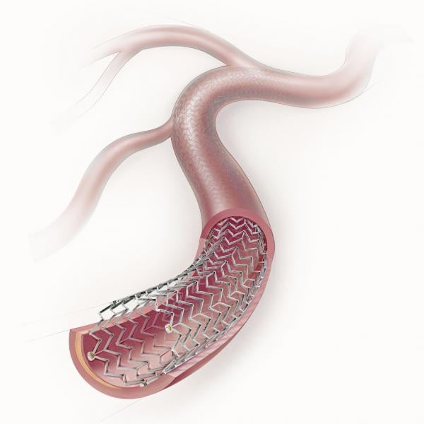 The safety of paclitaxel-eluting stents and drug-coated balloons was called into question in a recent study that showed higher mortality rates after two years. The Cook Zilver PTX paclitaxel-eluting peripheral stent is among the devices included in that study.