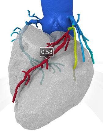 FFR-CT imaging developed by HeartFlow offers coronary flow data noninvasively. Clinical data so far shows close correlation with invasive catheter-based FFR measurements. The technology helps pinpoint ischemic culprit lesions and determine the severity of coronary stenosis.