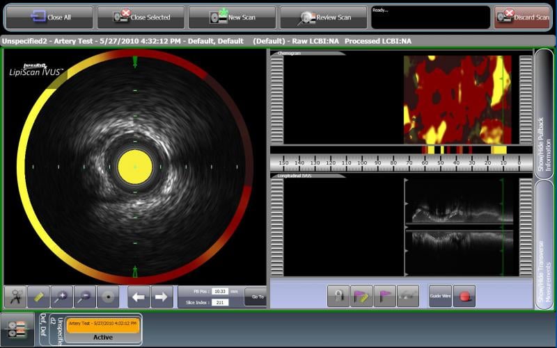 near-infrared spectroscopy, NIRS, heart attack, stroke, Infraredx, TVC