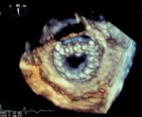An 3D echo view of a Neovasc Tiara transcatheter mitral valve. This valve is currently in clinical trials and is ahead of most of the TMVR devices in development.