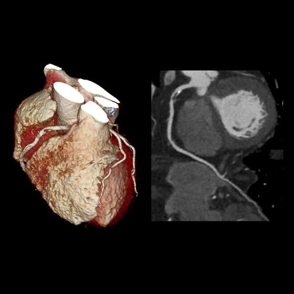 cardiac CT showing a severe right coronary artery lesion on a Toshiba Aquillion One