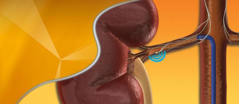 renal denervation clinical trial study hypertension cath medtronic symplicity