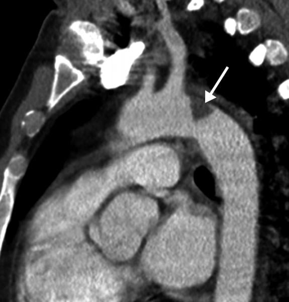 Thrombus formation in the aortic arch in a 46-year-old COVID patients in the ICU. Three trials are underway to find which anticoagulant strategy is best to treat moderate and critically ill patients where COVID-causes venous thrombo-embolism (VTE) is a major cause of complications. Image courtesy of Margarita Revzin et al.