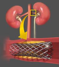 Journal of Endovascular Therapy Hypertension Renal Denervation Therapy