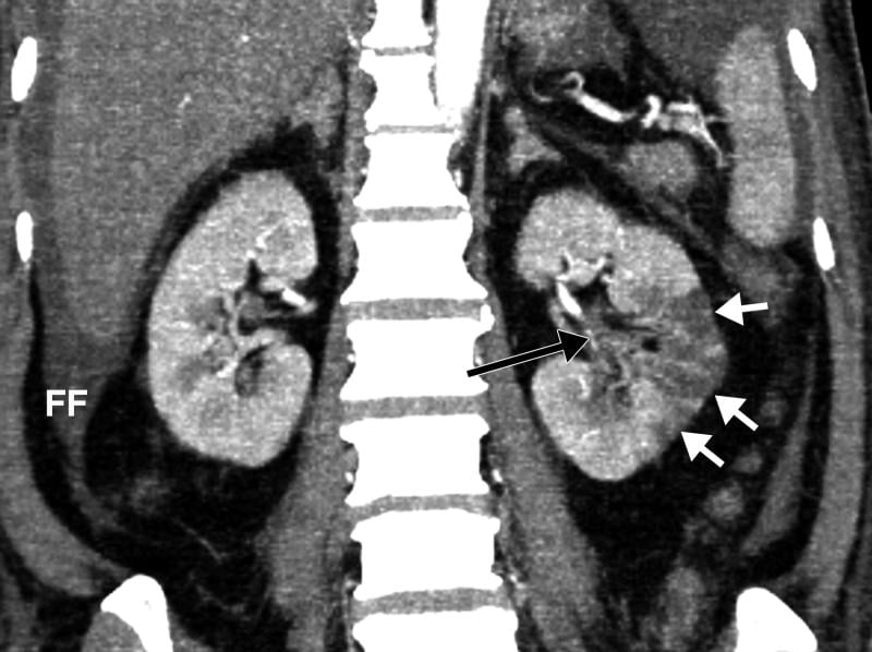 Example of kidney infarct organ damage caused by COVID-caused clotting in a 57-year-old man with COVID-19 who presented with abdominal pain. Image courtesy of Margarita Rezvin et al.  #COVID19 #SARSCoV2 #COVIDthrombus