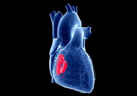 Physicians in the Smidt Heart Institute at Cedars-Sinai have pioneered using a catheter-based approach to treat patients with tricuspid valve disease. Image by Getty.