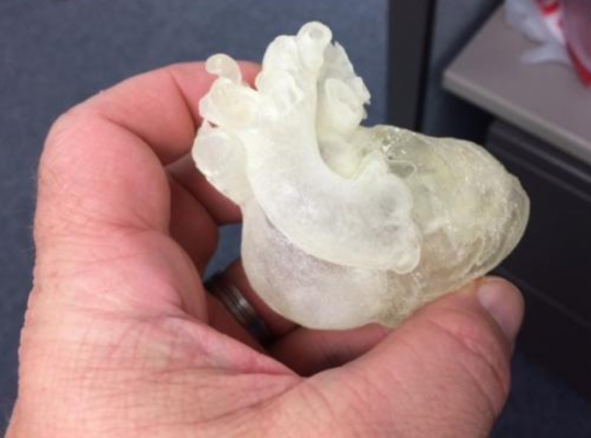 3d printing can aid procedural navigation in transcatheter tricuspid procedures