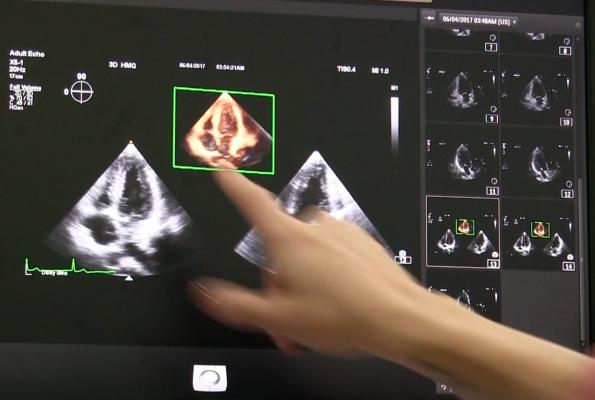 3-D Vascular Ultrasound Quantifies Plaque Burden to Estimate Cardiovascular Risk