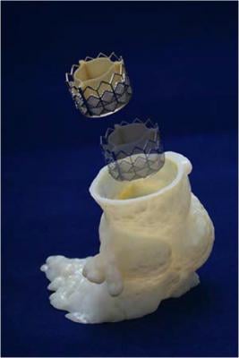 3-D printing, aortic valve model, aortic stenosis, Cleveland Clinic, ASE 2016