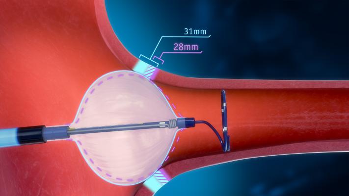 First-of-its-kind expandable cryoballoon catheter advances cryoablation therapy, addresses key limitations with traditional systems 