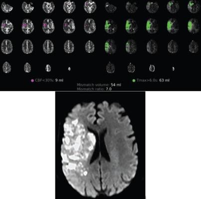 54-year-old patient with COVID-19 who underwent full angiographic reperfusion (extended thrombolysis in cerebral ischemia score = 3) after acute ischemic stroke. Top: Automated readout summary of CT perfusion data at presentation shows large mismatch volume (54 mL). Bottom: Follow-up MR image shows progression in infarction growth, with final infarction volume of approximately 72 cm3 (600% increase from CT perfusion imaging estimate of 9 mL shown in A). 
