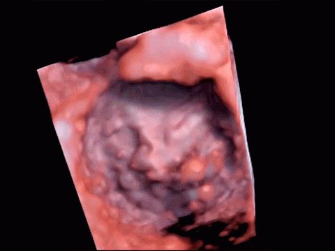  A 3-D view of the human heart’s mitral valve using the cSound image enhancement technology.
