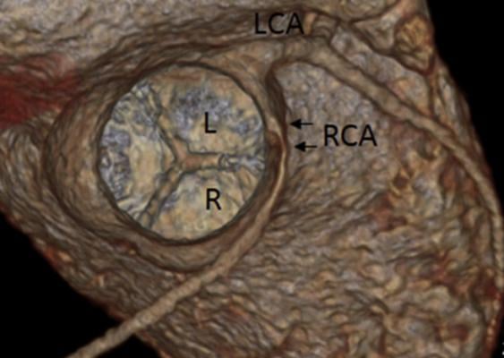 A 3-D CT reconstruction of an anomalous right coronary artery (RCA) can be seen arising from the left sinus of valsalva in a short-axis equivalent view. ASE issues New Guidelines for Multimodality Imaging of Congenital Coronary Anomalies 