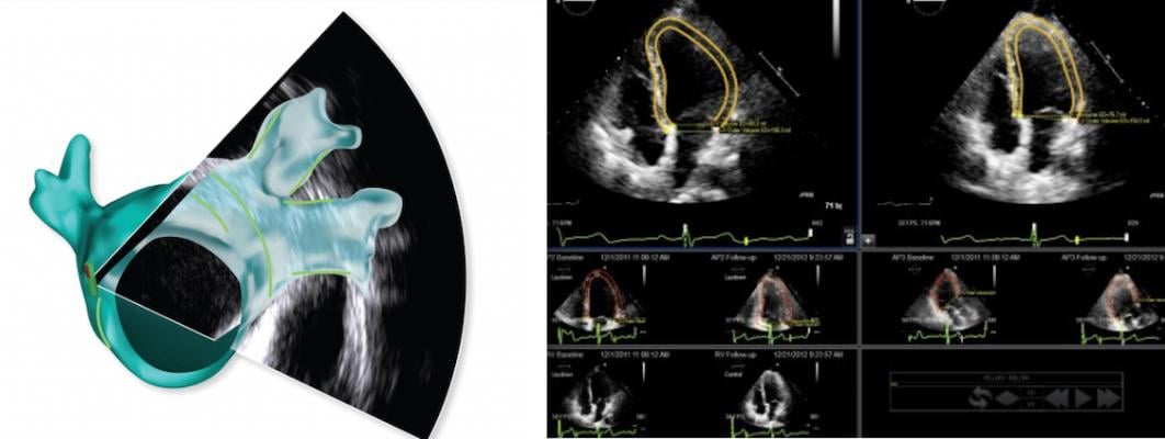 New cardiac ultrasound technologies featured at the American Society of Echocardiography 2021 Virtual Meeting include intracardiac ultrasound (ICE) imaging from Biosense Webster (left), and cloud-based, vendor-neutral strain imaging from Epsilon Imaging (right).