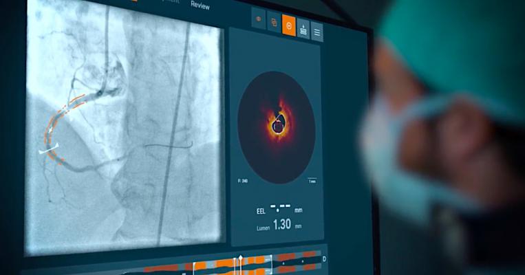 Abbott recently announced its new interventional imaging platform powered by Ultreon 1.0 Software, has gained European CE marked. This first-of-its-kind imaging software merges optical coherence tomography (OCT) intravascular imaging with the power of artificial intelligence (AI) for enhanced visualization. The new Ultreon Software can automatically detect the severity of calcium-based blockages and measure vessel diameter to enhance the precision of physicians’ decision-making during coronary stenting proc