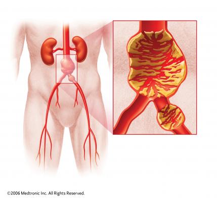 abdominal aortic aneurysm, AAA, gender differences, women vs. men, endovascular repair, Journal of Vascular Surgery study
