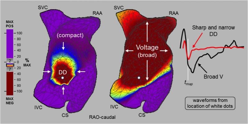 Charge Density Mapping Eliminates Repeat Ablation for Atrial Fibrillation at One Year
