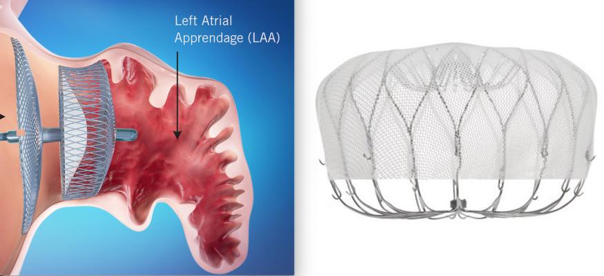 The two FDA-cleared transcatheter LAA occlusion devices on the U.S. market were compared in the SWISS-APERO and SEAL FLX trials presented at TCT 2021. Left is the Abbott Amulet device, right is the newest generation Watchman FLX device.