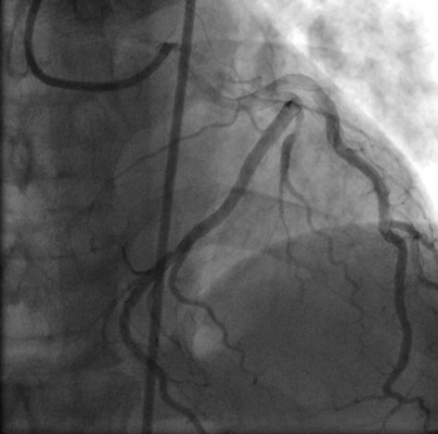 Angiogram of a STEMI patient.