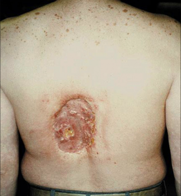 A patient injuried by extreme exposure to X-ray radiation during an angiography procedure, which is included among the images in the American College of Cardiology (ACC) consensus document. Angiography skin burn.
