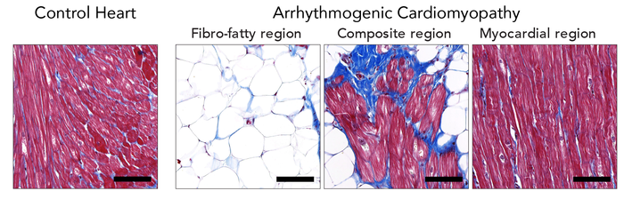A section of a normal healthy heart (left) and three locations in a heart from a patient with arrhythmogenic cardiomyopathy. There are a lot more fat cells (large while spheres) in the diseased heart. Cardiomyocytes in the composite region often show signs of degeneration, as well as enhanced ZBTB11 expression