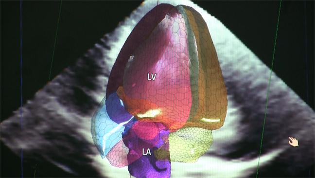Artificial intelligence( AI) has a rapidly growing presence in cardiology and across healthcare. This is an example of the Philips Healthcare Epiq ultrasound system using AI to automatically identify the cardiac anatomy in a 3-D scan. The AI also can pull the optimal views needed to eliminate operator variability. 