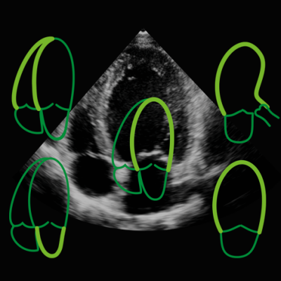 TomTec's auto strain assessment of the left ventricle on echo.