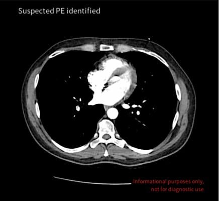 Avicenna.AI announces the introduction of Cina Chest, including AI tools for detection and emergency triage of pulmonary embolism and aortic dissection.