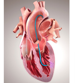 ECG, pulmonary. disease