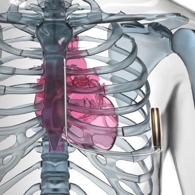 Emblem Subcutaneous ICD Safe and Effective for Majority of Patients