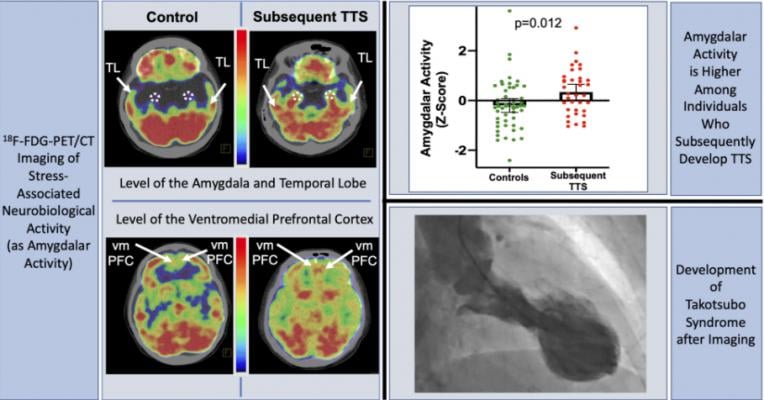 Researchers found a relationship between stress-associated neurobiological activity on 18F-FDG PET-CT imaging and risk for subsequent Takotsubo syndrome impacting the heart.