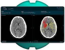 Strategic partnership increases access to advanced AI-assisted stroke care 