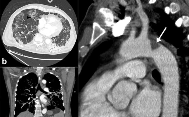 Examples of COVID-19 caused clotting with multiple pulmonary embolisms (PE) in left image, and a large thrombus in the aortic arch. Images courtesy of RSNA and Margarita Revzin et al. Find more clinical images of COVID.
