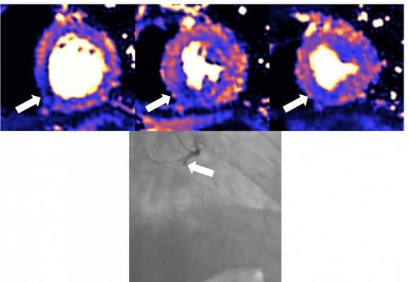 MRI scan of heart damaged by COVID, which can cause myocarditis, infarction and/or ischemia. Blue means reduced blood flow, orange is good blood flow. In this figure the inferior part of the heart shows dark blue, so the myocardial blood flow is very reduced. The angiogram shows the coronary artery which supplies the blood to this part of the heart is occluded. The three colored MRI images show different slices of the heart — the basal mid and apical slices. Image courtesy of European Heart Journal