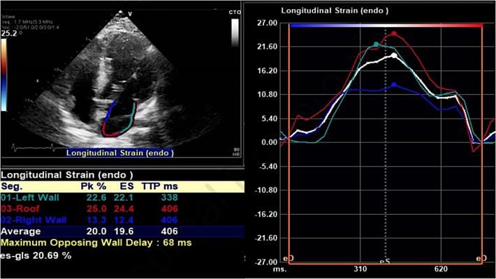 An example of a strain echo from the study showing reduced peak longitudinal/reservoir left atrial strain in a COVID-19 patient who developed atrial fibrillation during admission. Average left atrial strain here is 20% (normal should be above 38%). 