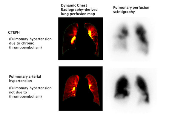 Published online November 8 in the journal, Radiology, the study enabled the visualization of pulmonary hemodynamics and perfusion with high sensitivity, specificity and diagnostic accuracy, and without the use of contrast media 